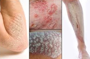 cara-mengobati-psoriasis