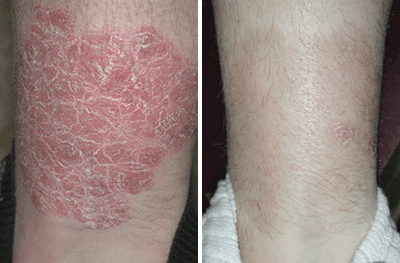 psoriasis before and after